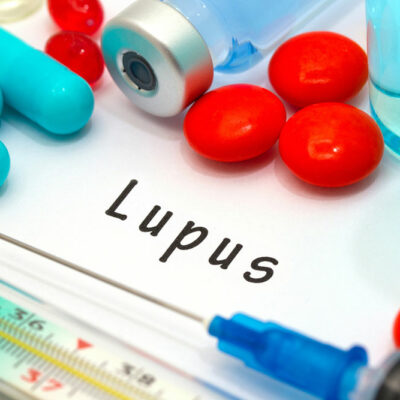 4 Major Risk Factors of Lupus