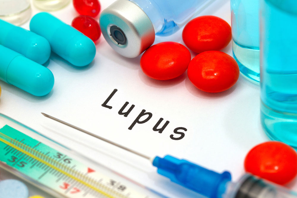 4 Major Risk Factors of Lupus