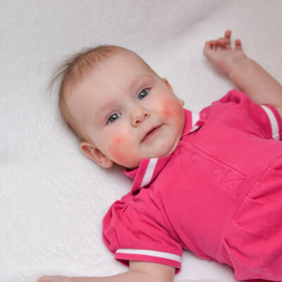 Natural Treatment Tips for Eczema in Babies