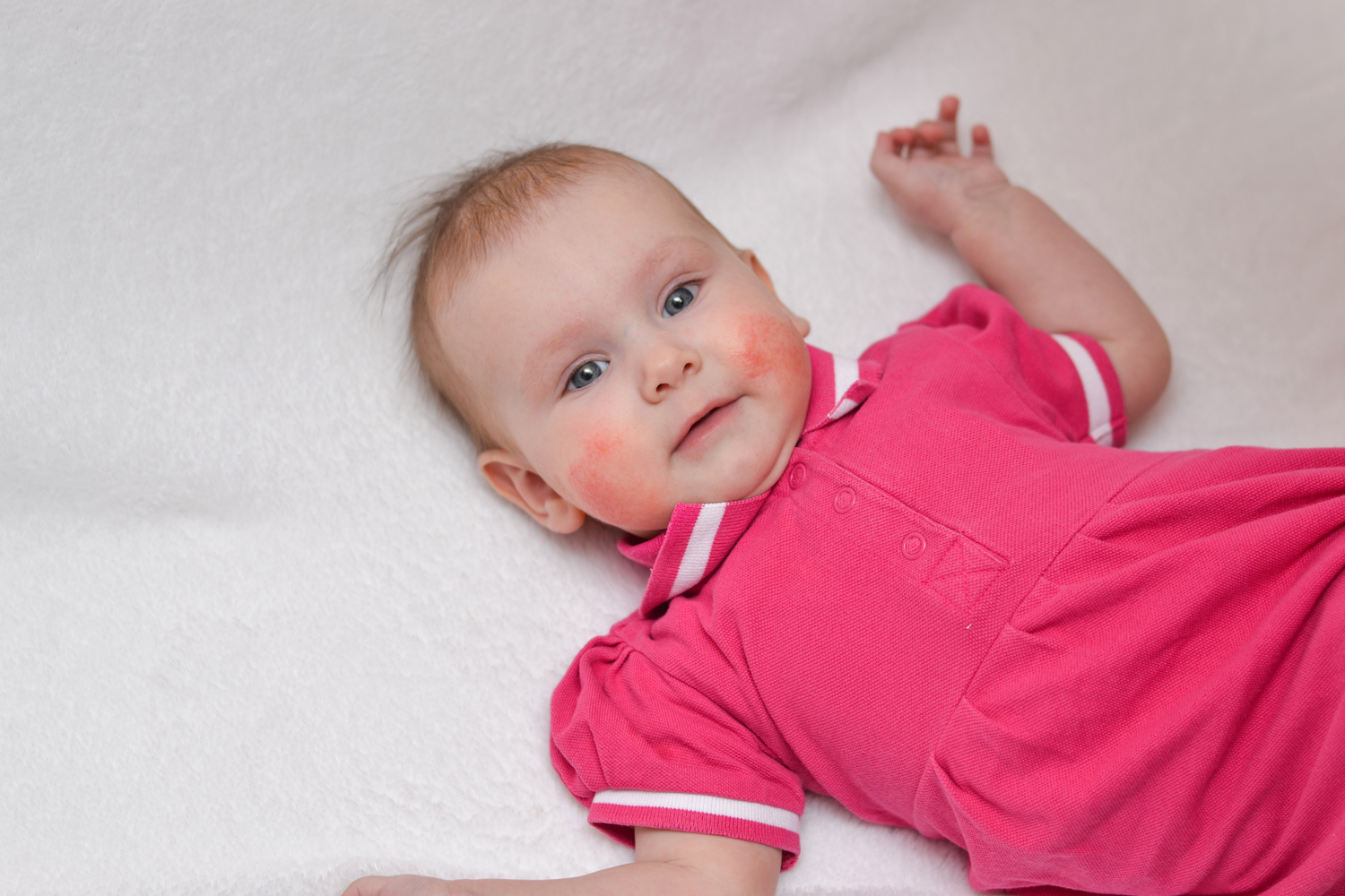 Natural Treatment Tips for Eczema in Babies