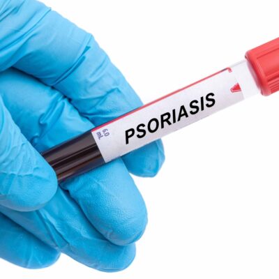 The Worst Foods For Psoriasis And Treatment Options