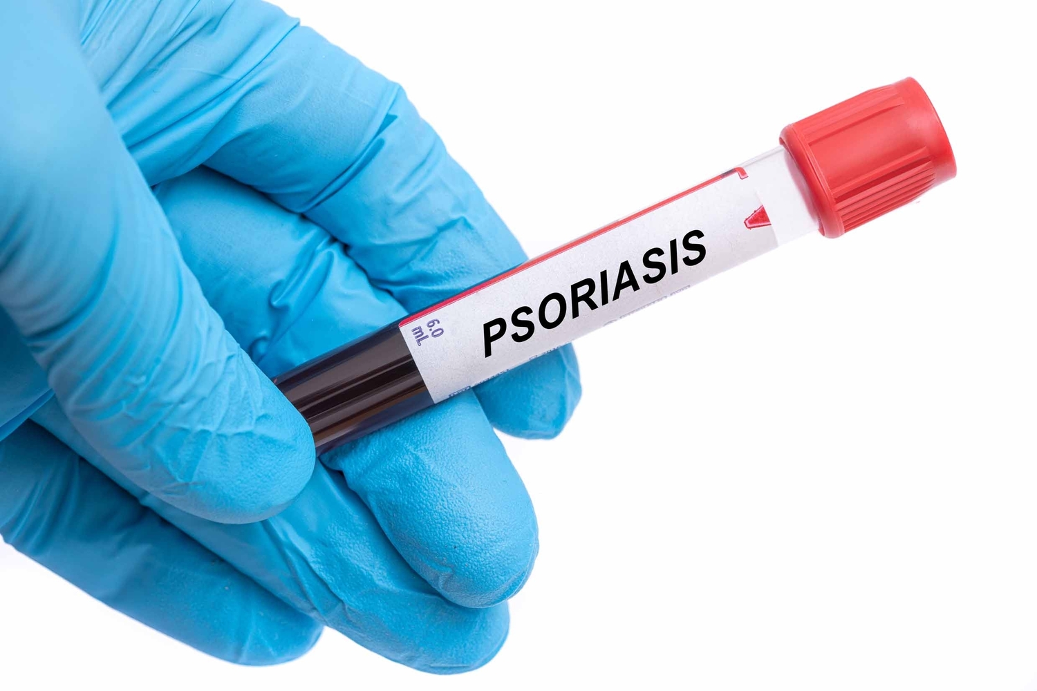 The Worst Foods For Psoriasis And Treatment Options