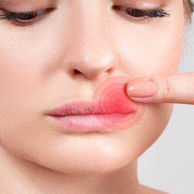 Silent signs and symptoms of herpes